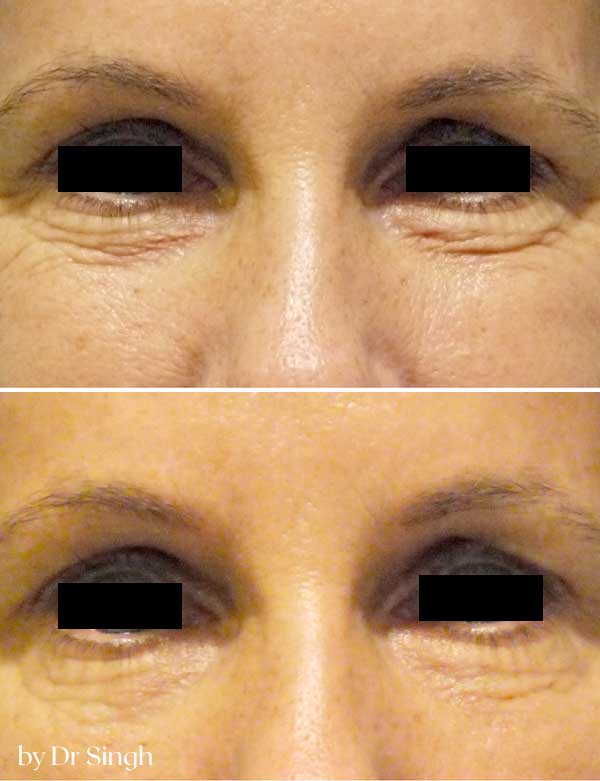 before after blepharoplasty nyc